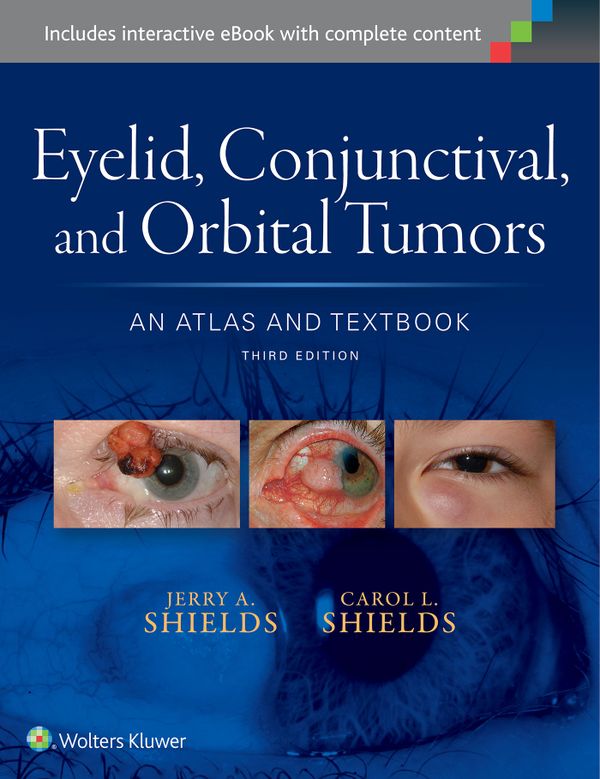 Eyelid, Conjunctival, and Orbital Tumors | 0:e upplagan