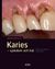 Karies : - sjukdom och hål