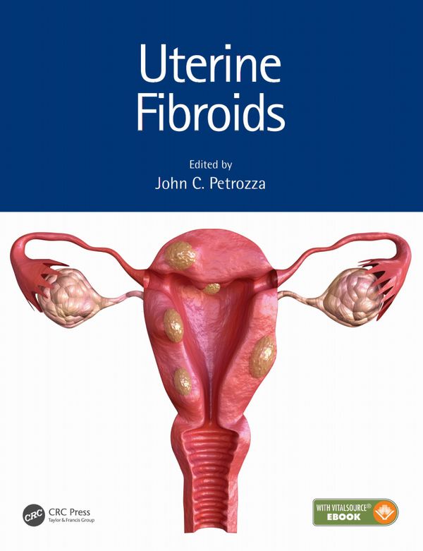 Uterine Fibroids | 1:a upplagan