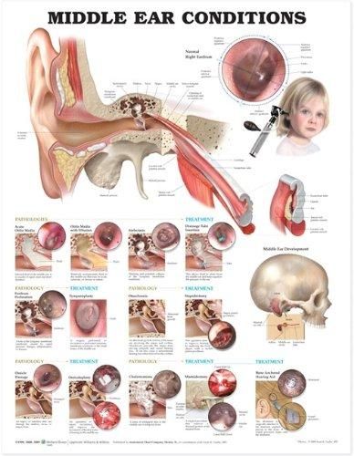 Middle Ear Conditions Anatomical Chart | 0:e upplagan