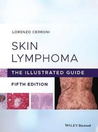 Skin Lymphoma