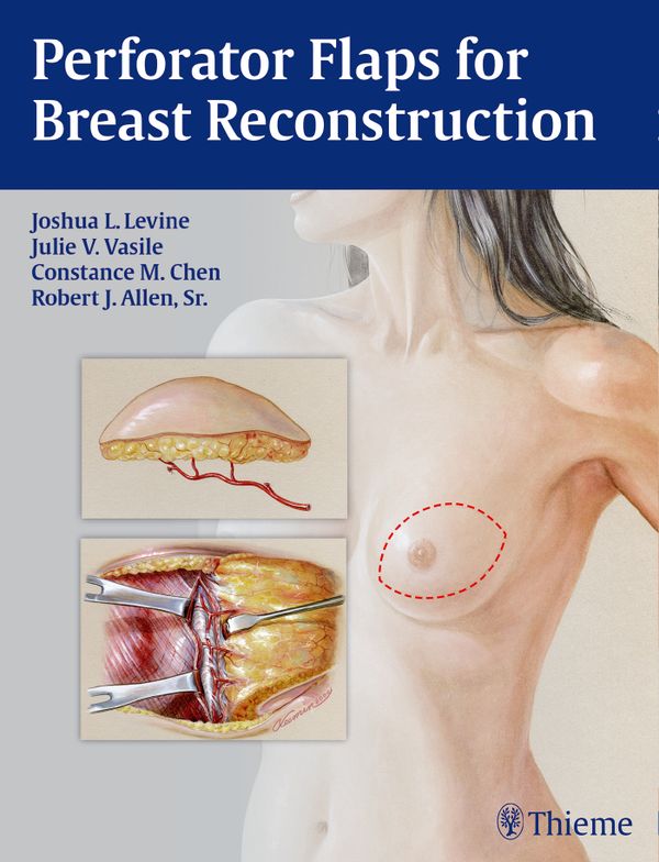 Perforator Flaps for Breast Reconstruction | 0:e upplagan