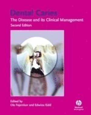 Dental Caries: The Disease and Its Clinical Management |  2:e upplagan