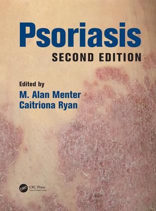 Psoriasis | 2:a upplagan