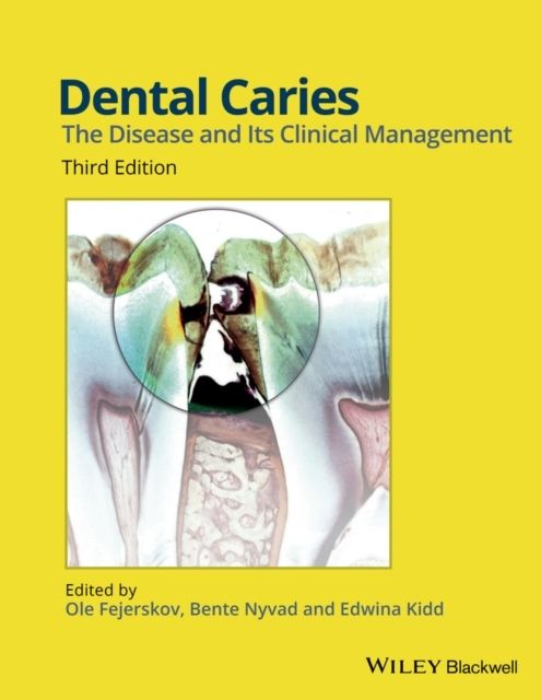 Dental Caries: The Disease and its Clinical Management, 3rd Edition | 1:a upplagan