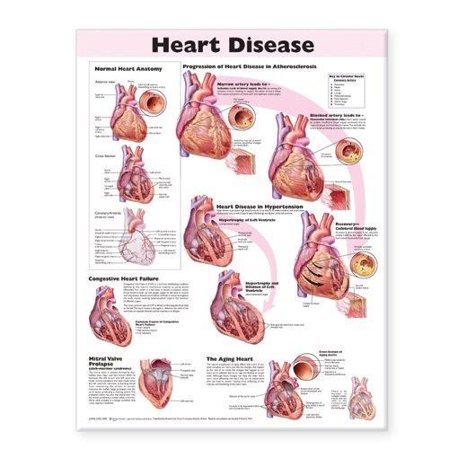 Heart Disease Anatomical Chart | 0:e upplagan