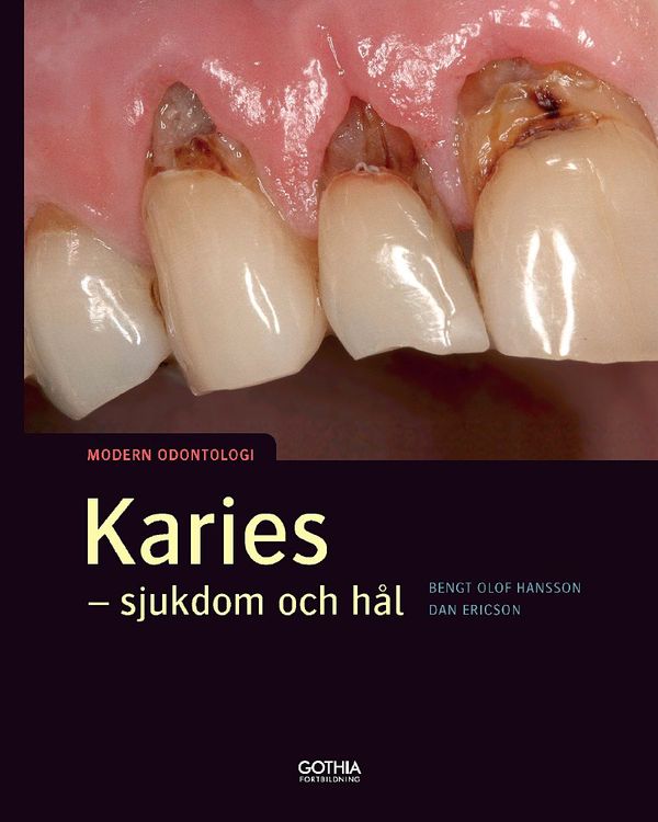 Karies : - sjukdom och hål | 0:e upplagan