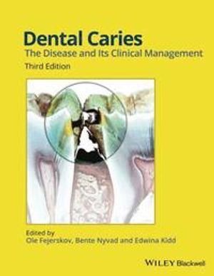 Dental Caries: The Disease and its Clinical Management | 1:a upplagan